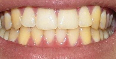 ¡No dejes que los dientes amarillos te impidan sonreír! diente amarillo