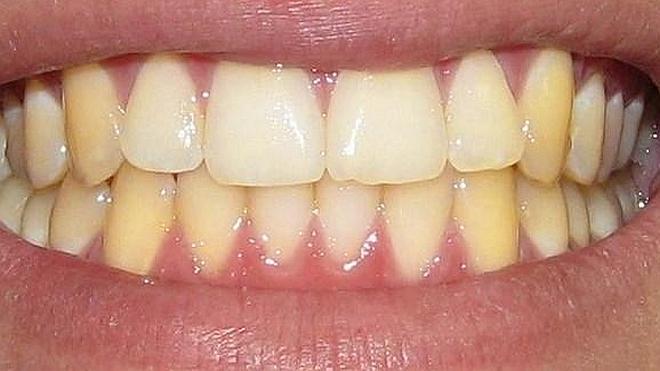 ¡No dejes que los dientes amarillos te impidan sonreír! diente amarillo