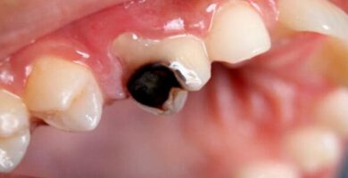 Las causas de los dientes podridos y cómo evitarlos. dientes podridos
