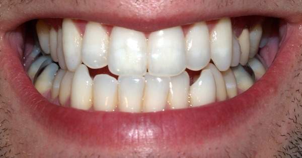 Los peligros de no tratar los dientes chuecos dientes chuecos