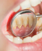 Cómo prevenir los dientes con sarro