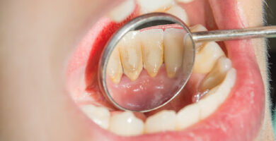 Cómo prevenir los dientes con sarro Cómo prevenir los dientes con sarro