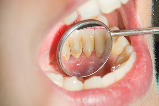 Cómo prevenir los dientes con sarro