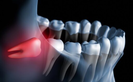 ¿Qué es un diente impactado?