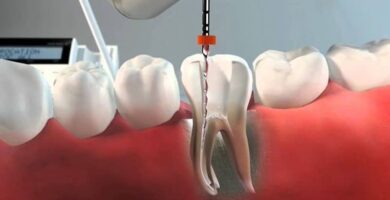 Endodoncia cuanto cuesta Endodoncia cuanto cuesta