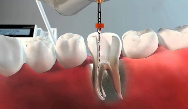 Endodoncia cuanto cuesta Endodoncia cuanto cuesta