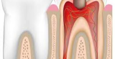 Muela quebrada endodoncia Muela quebrada endodoncia