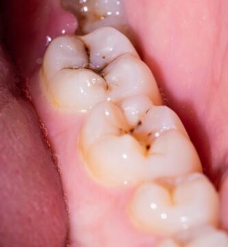 Muelas picadas Muelas picadas