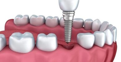 Porque un implante dental huele mal Porque un implante dental huele mal