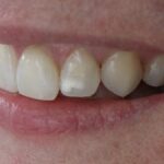 Diente con mancha blanca