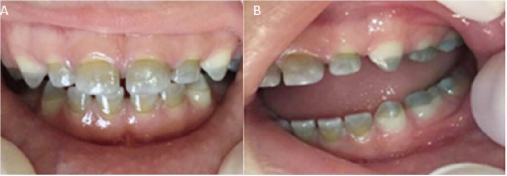 Dientes verdes Dientes verdes