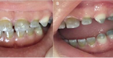 Dientes verdes Dientes verdes