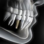 ¿Cuántos años dura el implante dental?