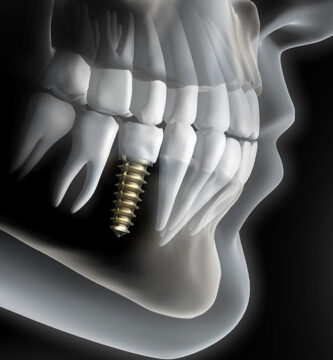 ¿Cuántos años dura el implante dental?