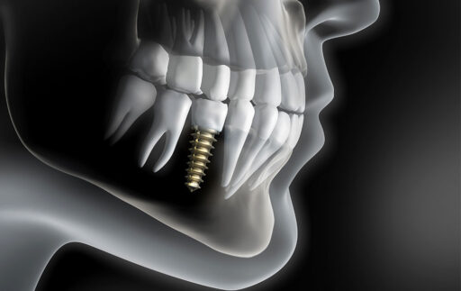 ¿Cuántos años dura el implante dental?